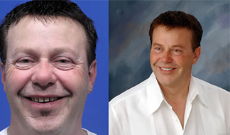 Drs. Kenneth Robin Rawlinson, LLC | Preventative Program, Invisalign reg and Dental Bridges