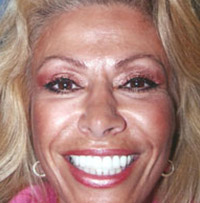 Drs. Kenneth Robin Rawlinson, LLC | Dental Bridges, Extractions and Veneers