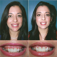 Drs. Kenneth Robin Rawlinson, LLC | Dental Bridges, Extractions and Sleep Apnea